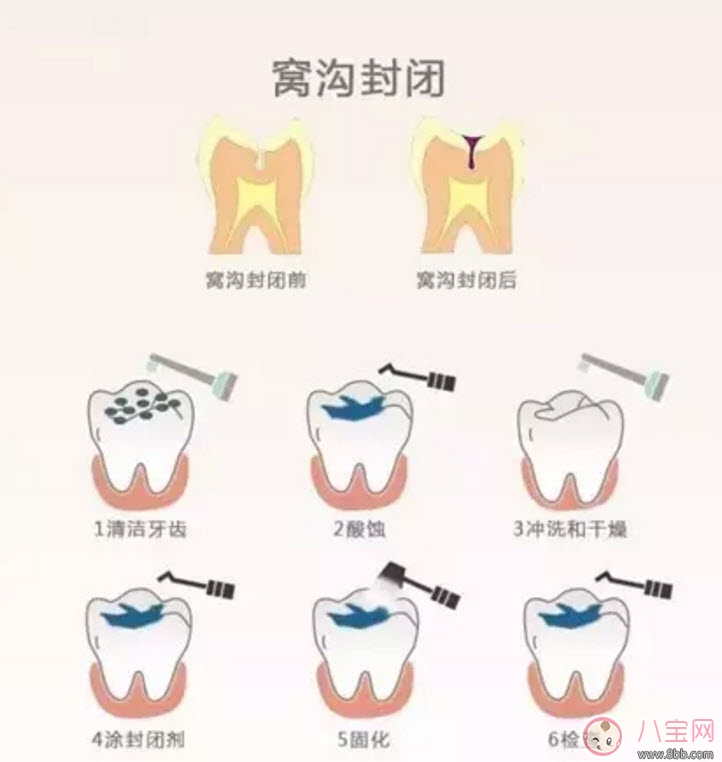 宝宝几岁做窝沟封闭 儿童做窝沟封闭好不好