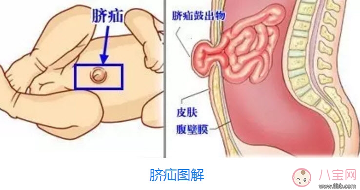 脐疝对宝宝有什么影响 宝宝脐疝是什么原因引起的