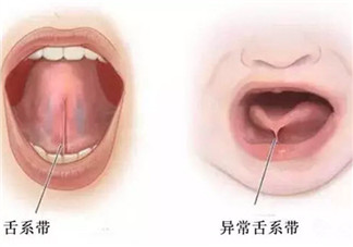 宝宝舌系带过短怎么办 舌系带过短一定要做手术吗