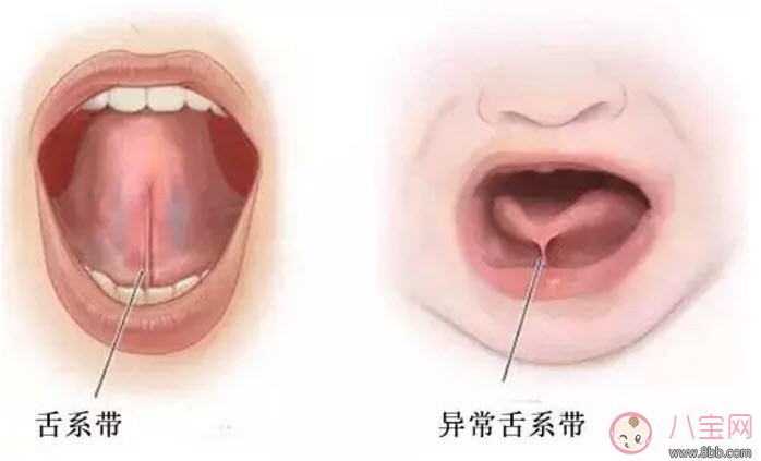 宝宝舌系带过短怎么办 舌系带过短一定要做手术吗