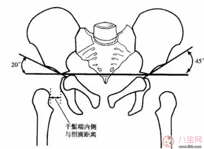 宝宝臀纹不对称怎么回事 臀纹不对称一定是髋关节发育不良吗