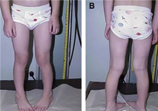 宝宝走路内八字怎么办 宝宝走路内八字的原因有哪些