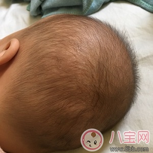 孩子睡觉后脑勺出汗很多 宝宝后脑勺出汗多是缺钙引起的吗