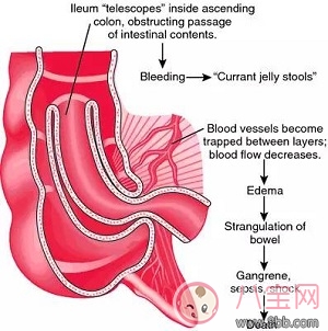 肠道叠的三大典型症状是什么 肠道叠是怎么引起的怎么治疗预防