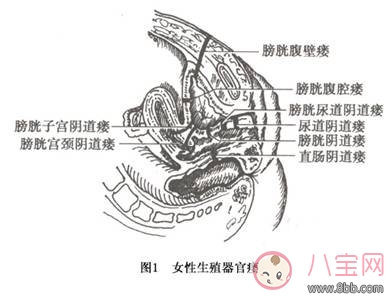 女性尿瘘是什么病引起尿瘘的主要原因 尿瘘有什么症状尿瘘手术有效吗