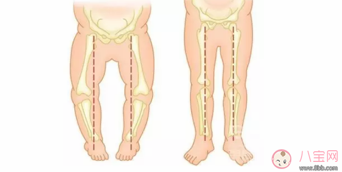 穿纸尿裤会让孩子O型腿吗 如何预防宝宝O型腿