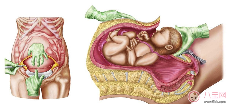 黄英剖腹产对身体有什么影响  剖腹产会延迟喂养母乳吗