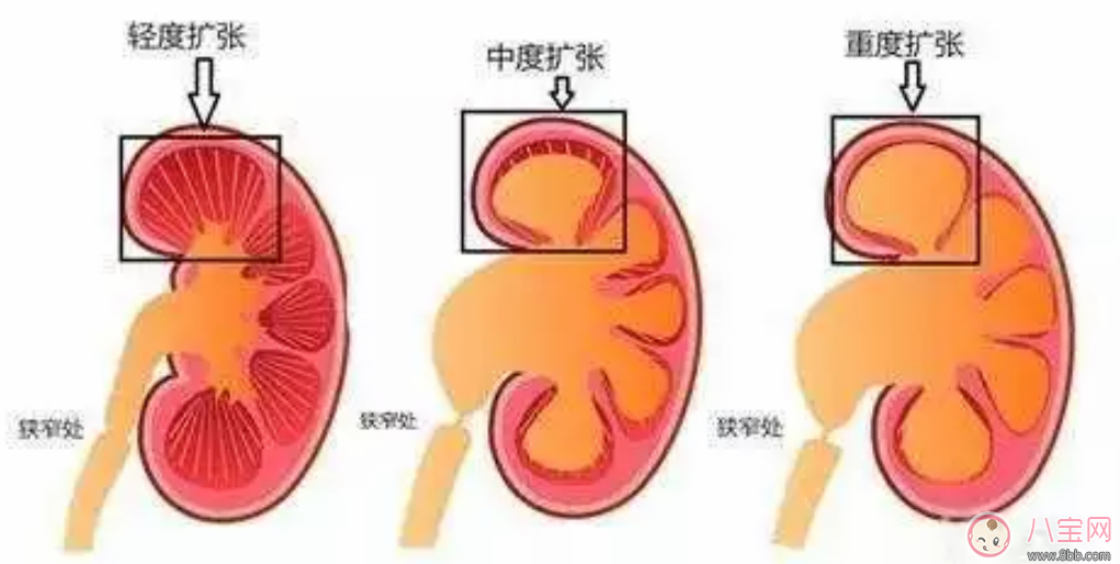 婴儿肾积水有哪些症状   婴儿肾积水能自愈吗