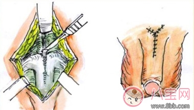 男性阴茎延长手术怎么做 阴茎延长手术所有人都能做吗