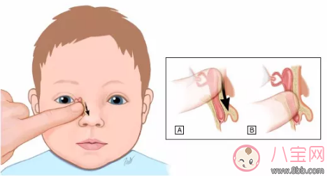 新生儿泪囊炎是什么病 孩子的眼屎应该怎么清理比较好