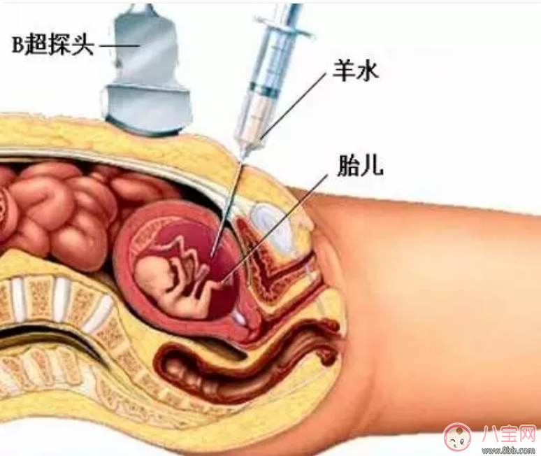 做羊水穿刺风险大吗 羊水穿刺几天能出结果