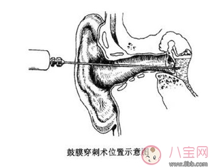 做完中耳炎手术后多久可以进行性生活 中耳炎手术之后会影响性生活吗