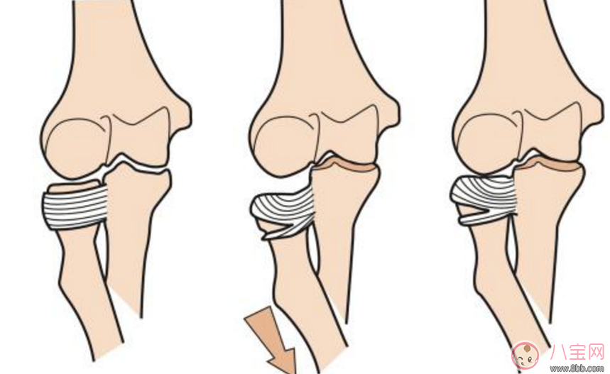 孩子得扯肘症怎么办 孩子脱臼了之后应该怎么治疗