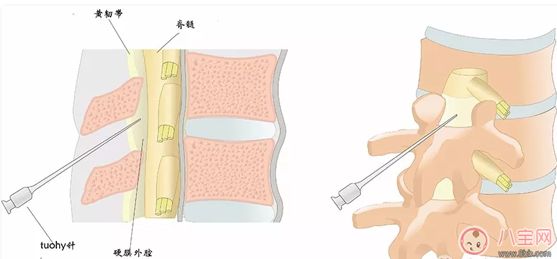 产后腰痛是因为打了麻醉吗 产后腰痛怎么缓解