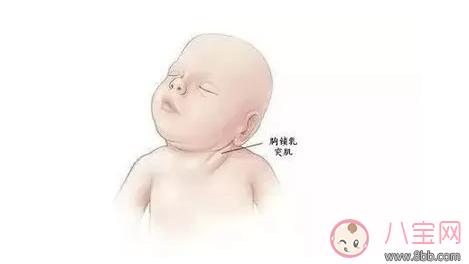 孩子歪脖子应该怎么治疗 孩子歪脖子有什么方法及时发现