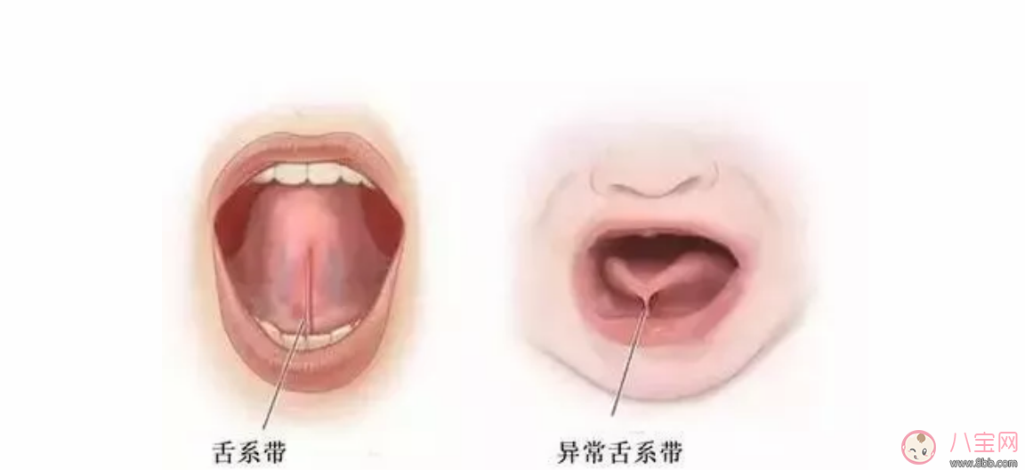 宝宝结舌如何影响语言发育 怎么治疗孩子的结舌