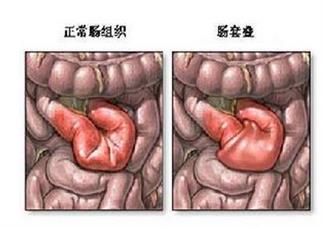 宝宝肠套叠是怎么引起的 肠套叠需要动手术吗