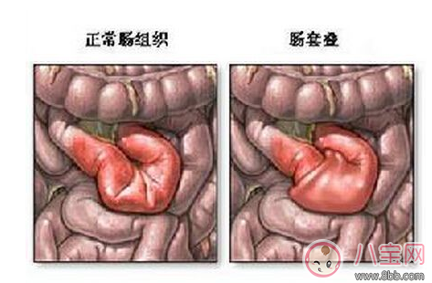 孩子|宝宝肠套叠是怎么引起的 肠套叠需要动手术吗