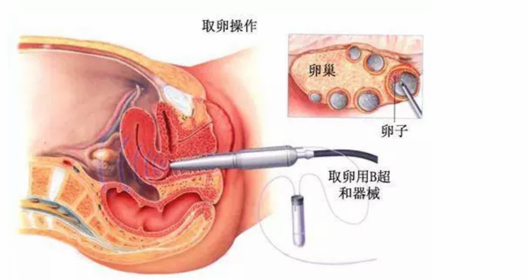 试管婴儿取卵时很痛吗 试管婴儿取卵很痛能不能打麻醉药