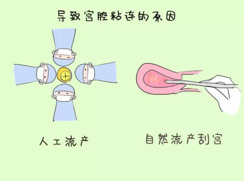 宫颈粘连可以做试管婴儿吗 宫颈粘连会不会影响试管成功率