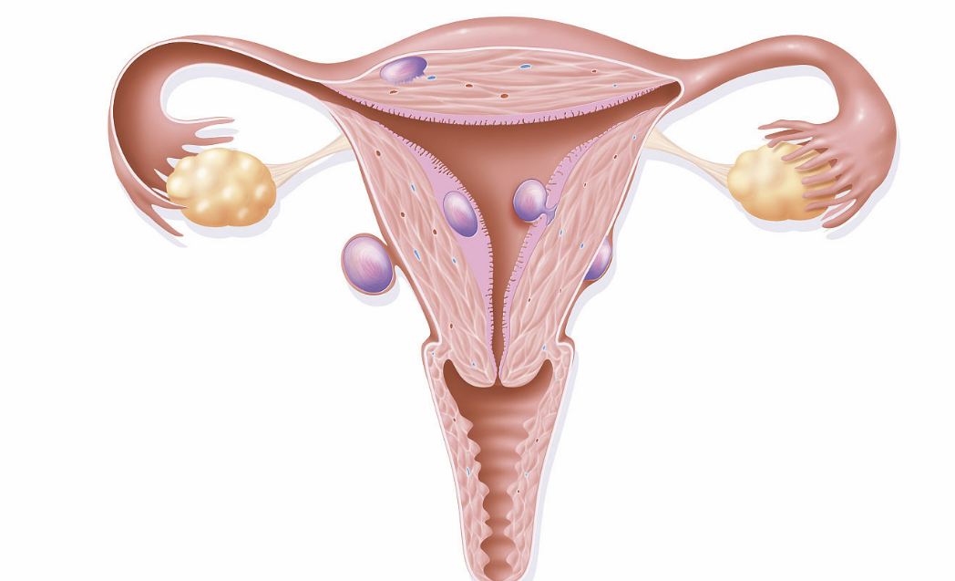 哪些人容易出现卵巢肿瘤 孕期出现卵巢肿瘤怎么办