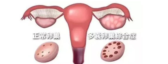 试管婴儿宫外孕怎么办2018 预防胚胎移植宫外孕注意事项