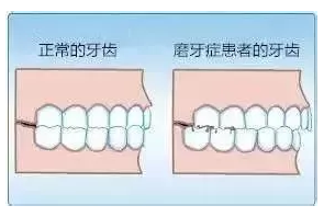 孩子睡觉喜欢磨牙怎么 孩子睡觉磨牙可以改掉吗