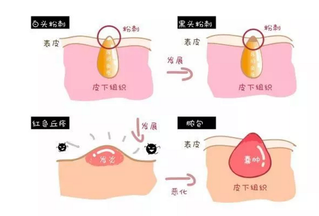 闭口是什么样子的长闭口了怎么改善2018