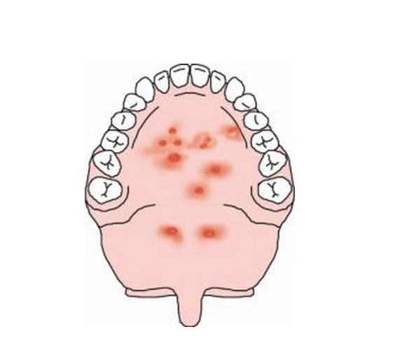 疱疹性咽峡炎是什么病 怎么预防疱疹性咽峡炎2018