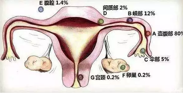 哪些因素会增加宫外孕的风险 准妈妈宫外孕是什么原因导致的