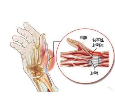 如何预防妈妈手 腱鞘炎不治能好吗