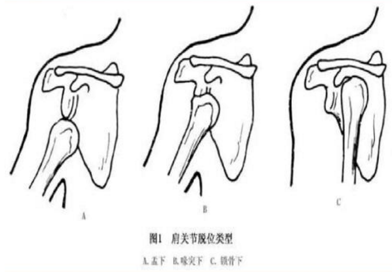 生活中哪些行为容易导致孩子脱臼 为什么孩子手容易脱臼