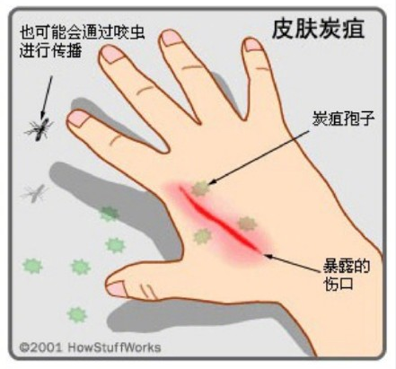 黑龙江感染炭疽病有多少人 黑龙江感染炭疽疫情是怎么回事