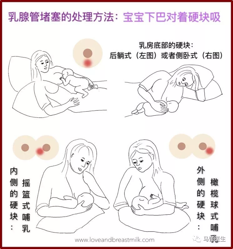 哺乳妈妈遇到堵奶了怎么办 为什么会发生堵奶