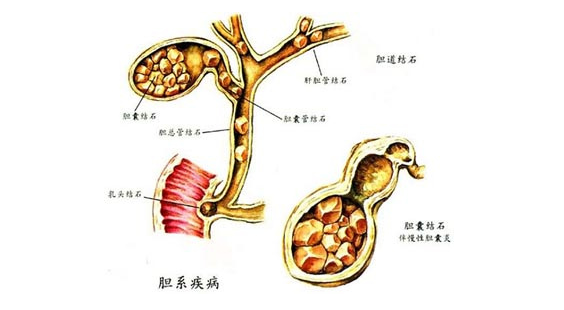 苹果汁治疗胆结石是真的吗 胆结石是怎么形成的