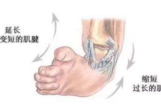 宝宝足内翻怎么判断   宝宝足内翻的症状