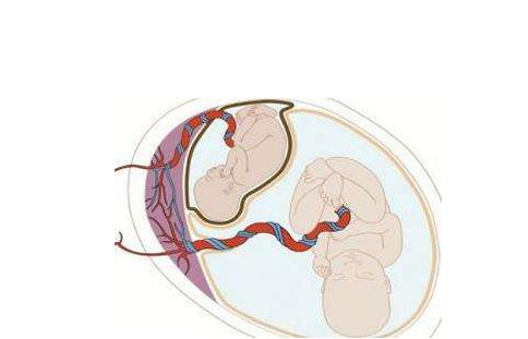帆状胎盘有什么危害 帆状胎盘是什么原因引起的