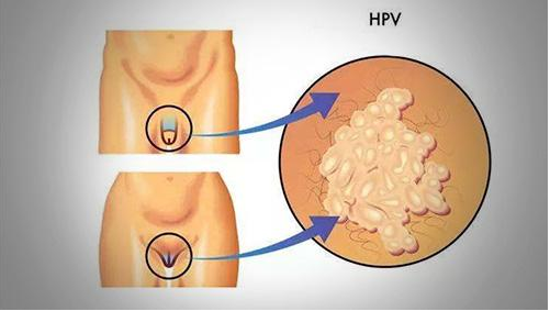 什么是女性假性湿疣 假性湿疣会自行自愈吗
