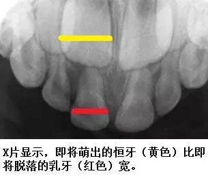 宝宝|宝宝牙齿有缝怎么办牙齿有缝正常吗