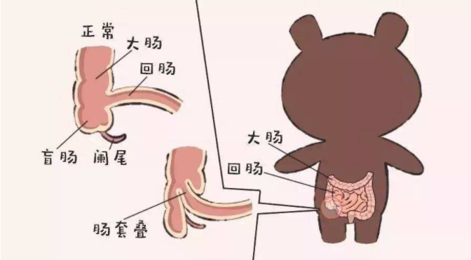 宝宝得了肠套叠会怎么样 宝宝肠套叠会自己好吗