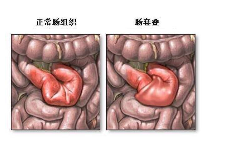 宝宝得了肠套叠怎么办 小儿肠套叠是什么造成的