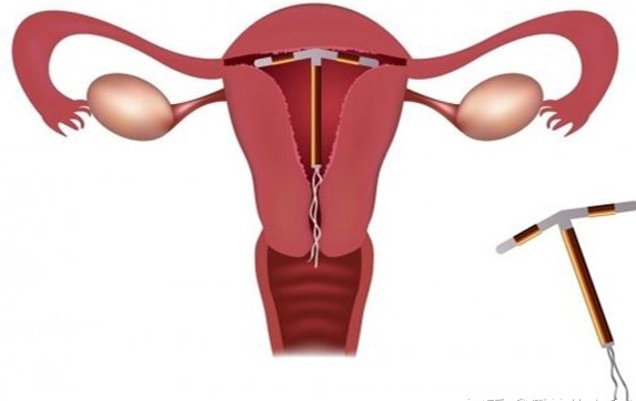 节育环有副作用吗 节育环副作用介绍