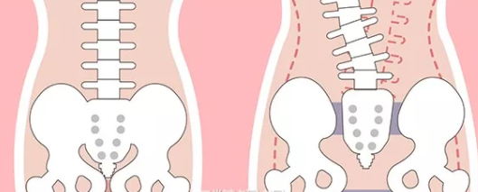 产后骨盆修复有必要做吗 骨盆恢复需要去医院吗