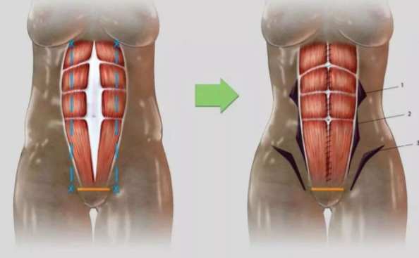 产后腹直肌分离锻炼恢复方法 腹直肌分离怎么锻炼