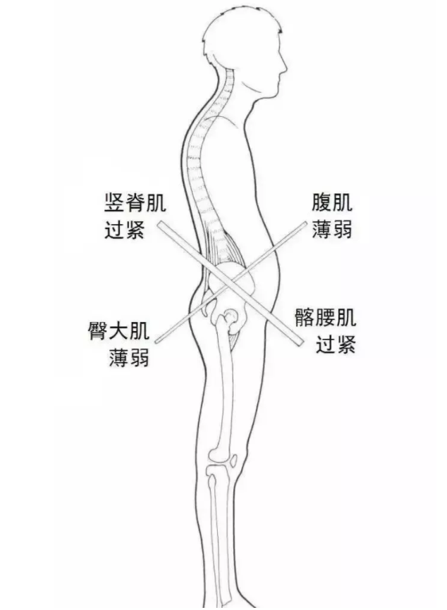 如何自测骨盆前倾 骨盆前倾怎么纠正