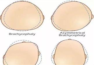 宝宝的头多大会定型 宝宝头型要怎么去睡