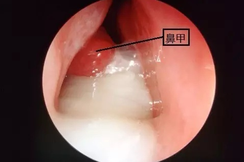 清鼻涕黄鼻涕颜色不同是为什么 清鼻涕黄鼻涕的区别