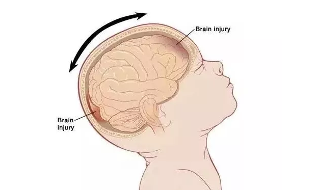 安抚宝宝的时候摇晃宝宝有什么影响 婴儿摇晃综合征是什么病