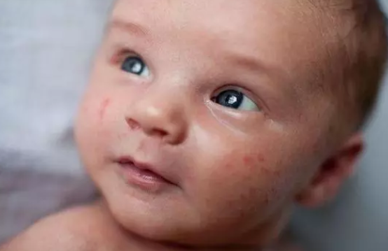 营养|婴儿奶粉过敏怎么选择奶粉 婴儿防过敏奶粉怎么选择