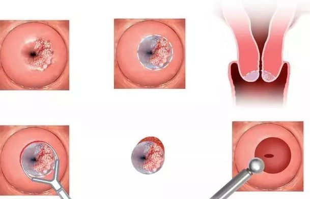 宫颈糜烂会变成宫颈癌吗 有症状的宫颈糜烂怎么处理